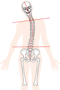 ぎっくり腰の原因になる背骨と骨盤の歪みの図