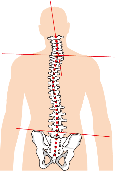 背骨の歪み
